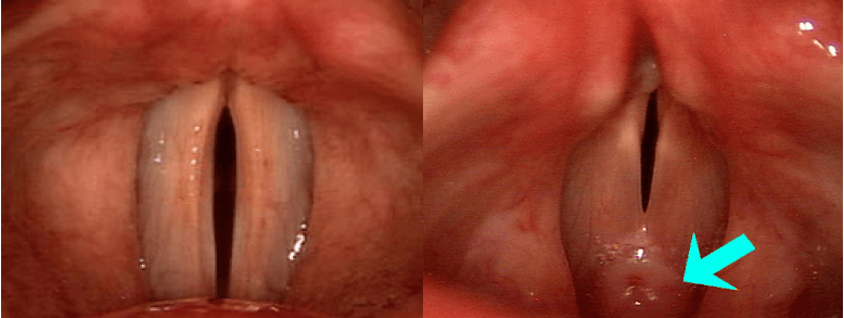 voice feminization surgery