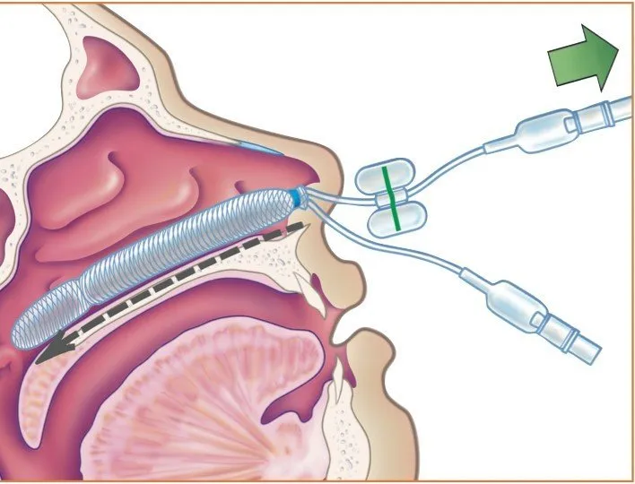endoskopik sinus cerrahisi