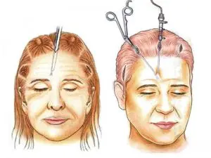 endoskopik yuz gerdirme