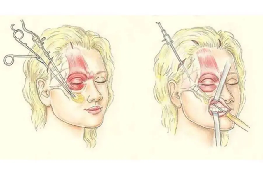 شد الوجه بالمنظار