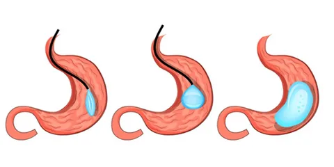 mide balonu mide balonu