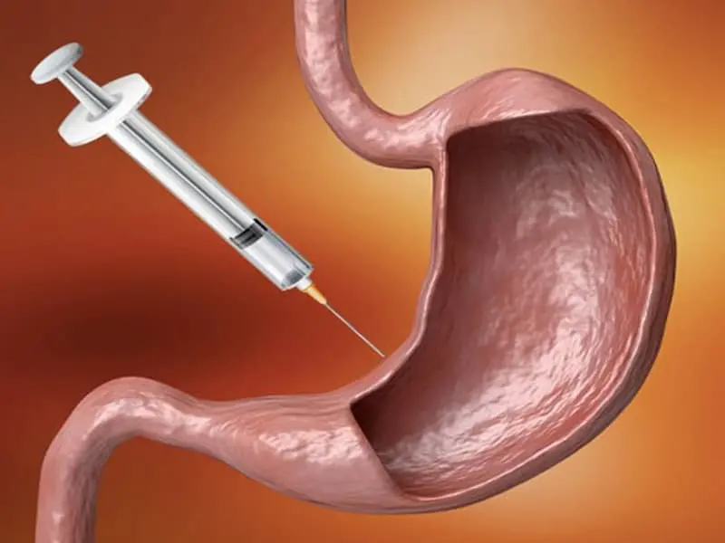 mide–botoksu mide botoksu